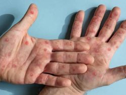 Seorang Warga Brebes Alami Gejala Klinis Cacar Monyet, Begini Cirinya