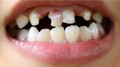 Mitos Mimpi Gigi Copot, Akan Ada Yang Meninggal